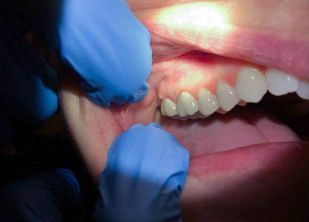 Best Urgent Care for Lost Fillings or Crowns in East Sandwich, MA